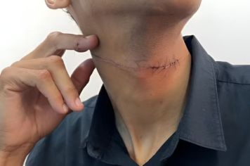 Motociclista fica ferido no pescoço ao ser atingido por linha chilena