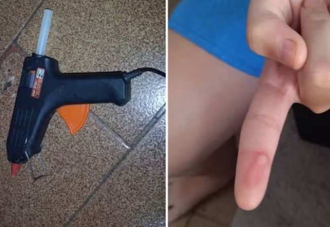 Mães denunciam professora suspeita de queimar alunos com cola quente durante aula de artes em escola municipal
