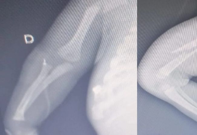 Pai é preso após confessar agressão a bebê de 6 meses 