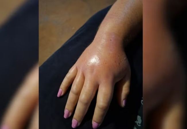 Mulher é picada por cobra durante colheita e relata dor “insuportável”: ‘Achei que fosse morrer’